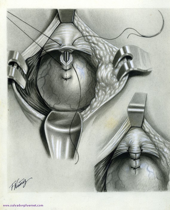 prostatectomía radical abierta técnica quirúrgica